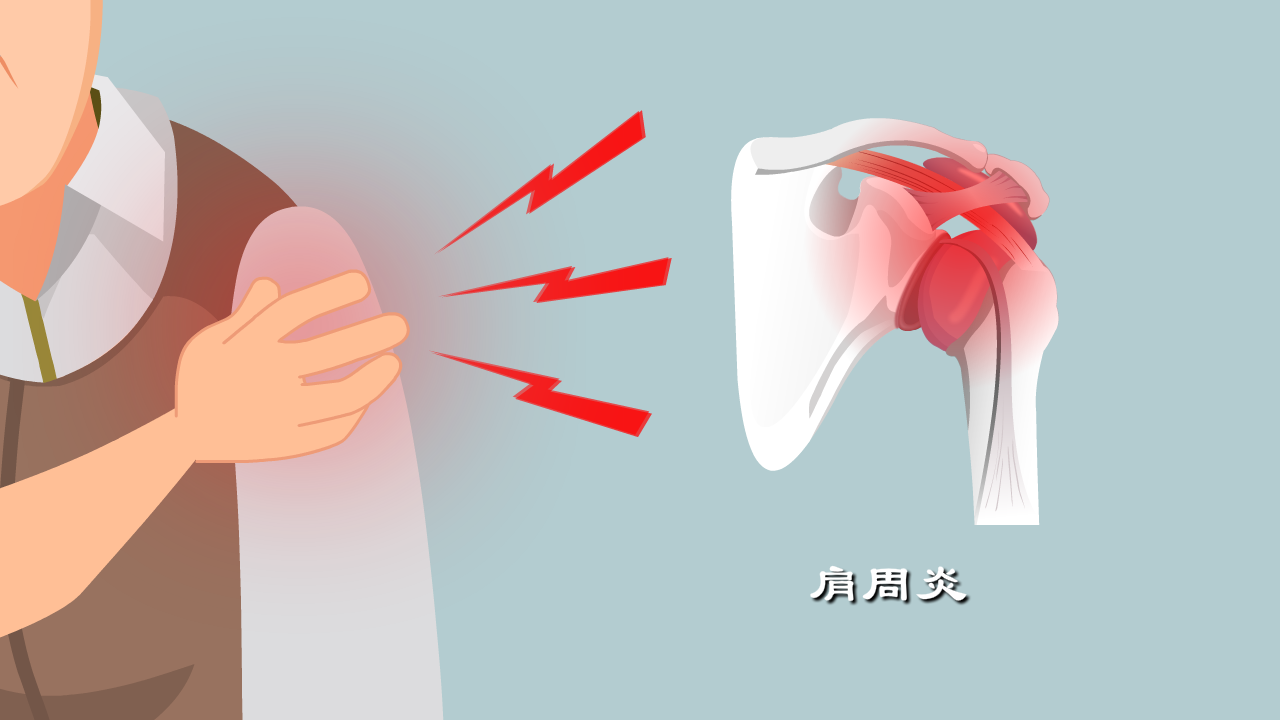 肩膀痛是肩周炎还是其他问题？一文教你分清
