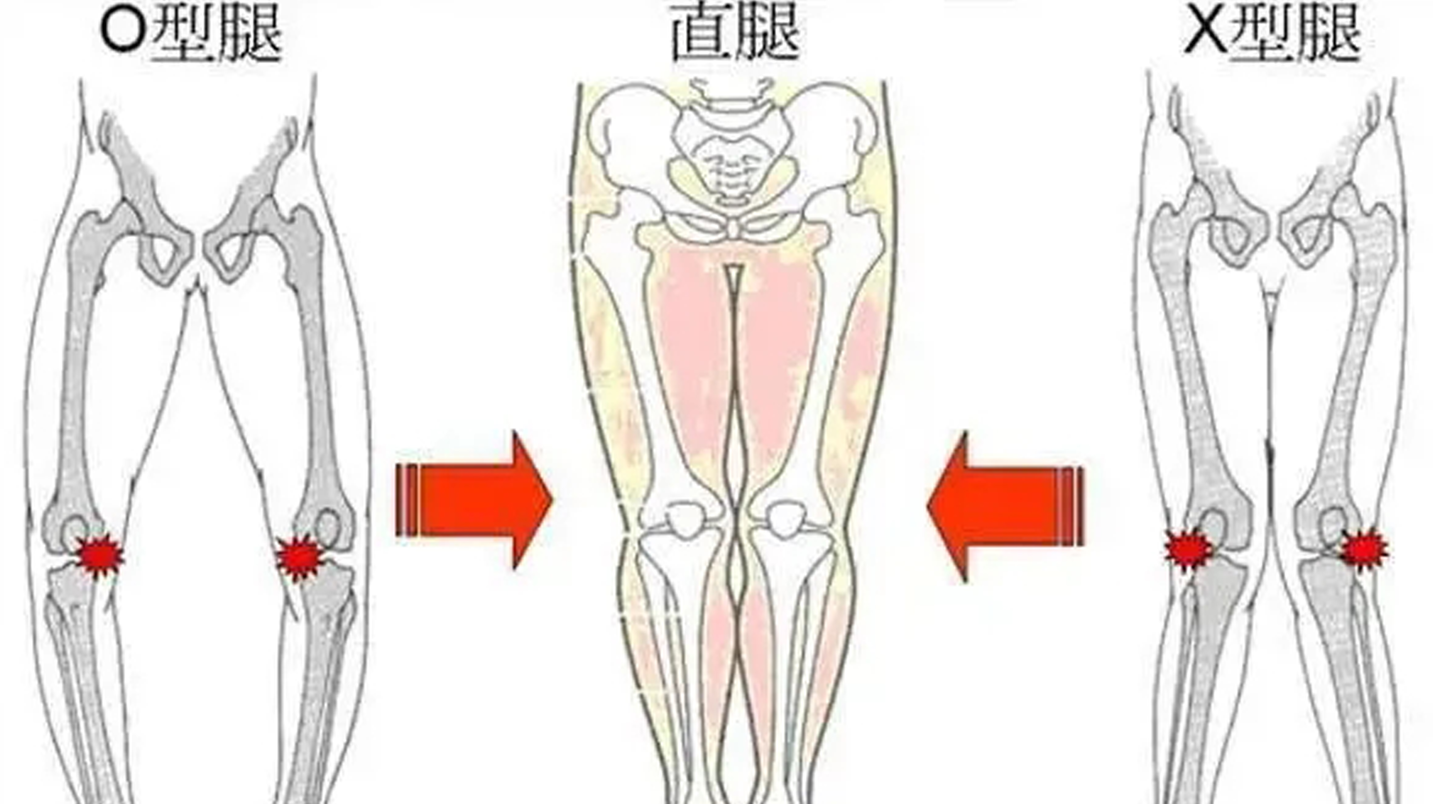 膝关节炎的诊断、治疗、康复!